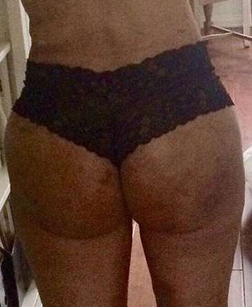 Brazilian Butt Lift for Thinner Patients Before & After Patient #7033