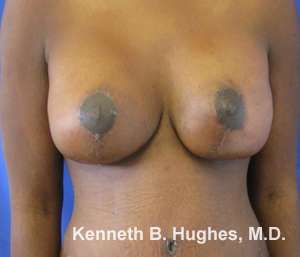 Breast Augmentation and Lift Before & After Patient #7041