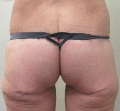 Body Lift Before & After Patient #5966