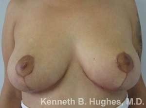 Breast Augmentation and Lift Before & After Patient #7073