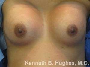 Breast Augmentation and Lift Before & After Patient #7082