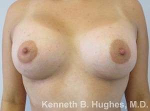 Breast Augmentation and Lift Before & After Patient #7094