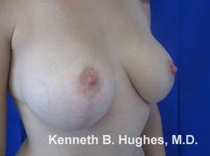 Breast Augmentation and Lift Before & After Patient #7097