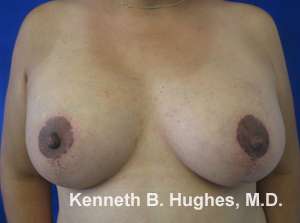 Breast Augmentation and Lift Before & After Patient #7100