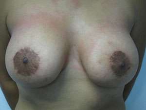 Breast Augmentation and Lift Before & After Patient #7121