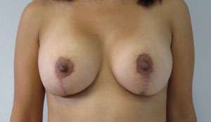 Breast Augmentation and Lift Before & After Patient #7124