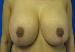 Breast Augmentation and Lift Before & After Patient #7127