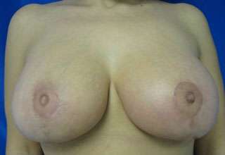 Breast Augmentation and Lift Before & After Patient #7133