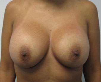 Breast Augmentation and Lift Before & After Patient #7148