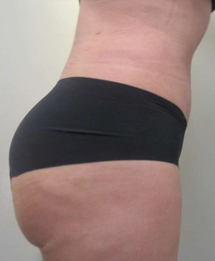 Body Lift Before & After Patient #5975