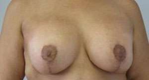 Breast Augmentation and Lift Before & After Patient #7157