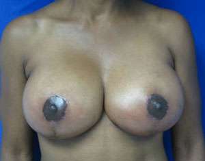 Breast Augmentation and Lift Before & After Patient #7164