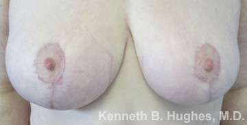 Breast Augmentation and Lift Before & After Patient #7167