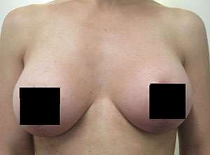 Breast Augmentation and Lift Before & After Patient #7177