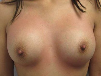 Breast Augmentation Implants Before & After Patient #7205