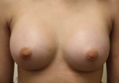 Breast Augmentation Implants Before & After Patient #7214