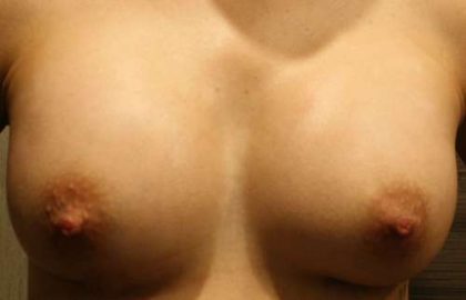 Breast Augmentation Implants Before & After Patient #7217