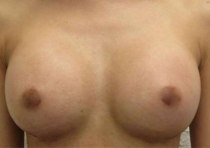 Breast Augmentation Implants Before & After Patient #7220