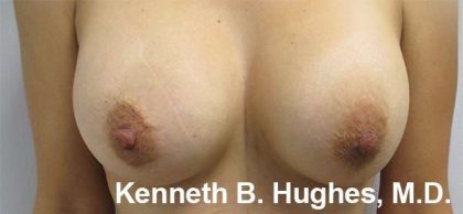 Breast Augmentation Implants Before & After Patient #7226