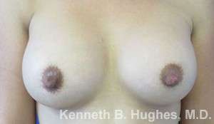 Breast Augmentation Implants Before & After Patient #7239