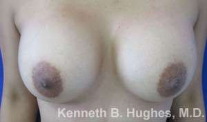 Breast Augmentation Implants Before & After Patient #7242