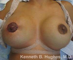 Breast Augmentation Implants Before & After Patient #7245