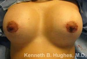 Breast Augmentation Implants Before & After Patient #7248