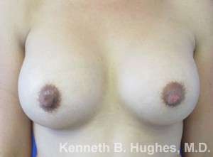 Breast Augmentation Implants Before & After Patient #7251
