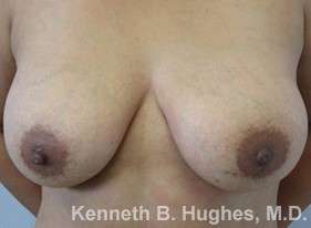 Breast Augmentation Implants Before & After Patient #7257