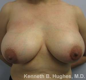Breast Augmentation Implants Before & After Patient #7260