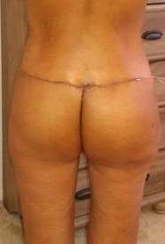 Body Lift Before & After Patient #5988