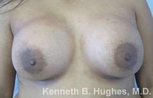 Breast Augmentation Implants Before & After Patient #7266