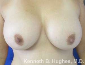 Breast Augmentation Implants Before & After Patient #7269