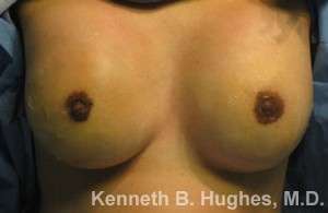 Breast Augmentation Implants Before & After Patient #7272