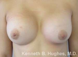 Breast Augmentation Implants Before & After Patient #7275