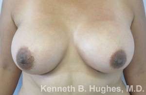 Breast Augmentation Implants Before & After Patient #7278