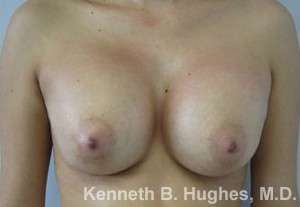Breast Augmentation Implants Before & After Patient #7290