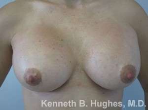 Breast Augmentation Implants Before & After Patient #7293