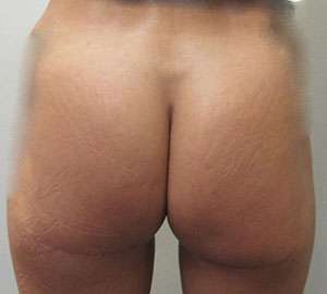 Body Lift Before & After Patient #5991