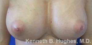 Breast Augmentation Implants Before & After Patient #7302