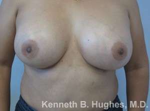 Breast Augmentation Implants Before & After Patient #7305