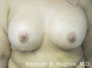 Breast Augmentation Implants Before & After Patient #7311