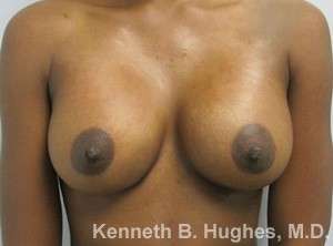 Breast Augmentation Implants Before & After Patient #7317