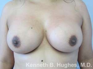 Breast Augmentation Implants Before & After Patient #7320