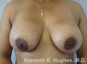 Breast Augmentation Implants Before & After Patient #7323