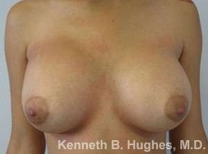 Breast Augmentation Implants Before & After Patient #7326