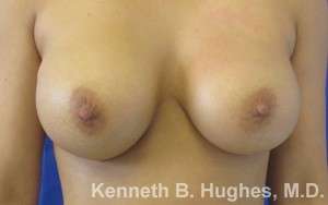 Breast Augmentation Implants Before & After Patient #7329