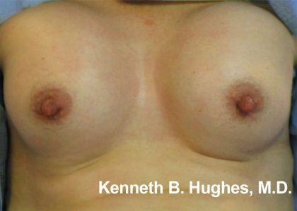 Breast Augmentation Implants Before & After Patient #7335