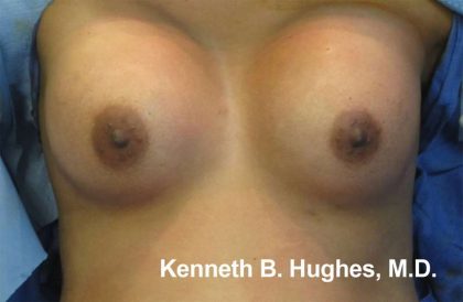 Breast Augmentation Implants Before & After Patient #7338