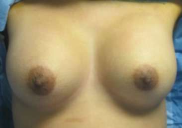 Breast Augmentation Implants Before & After Patient #7344